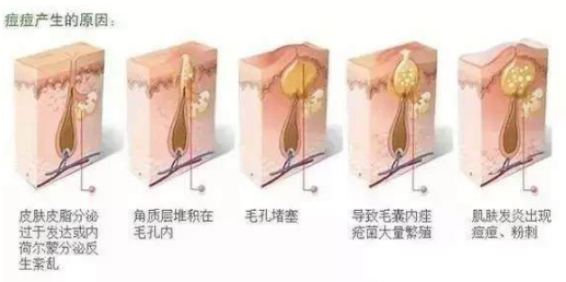 長痘痘