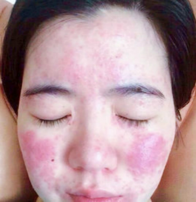 激素臉