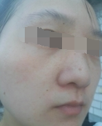 二次復診