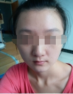 三次復診