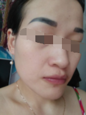 二次復診