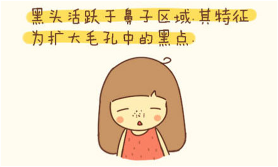 鼻子上的小黑頭