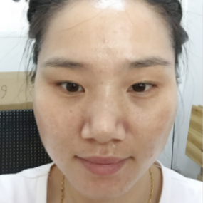 我與珍妮膚的抗痘故事
