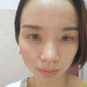 我的戰痘坎坷歷程
