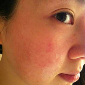 如何擺脫敏感性肌膚？