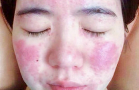 珍妮膚護膚小技巧：激素臉如何護理？